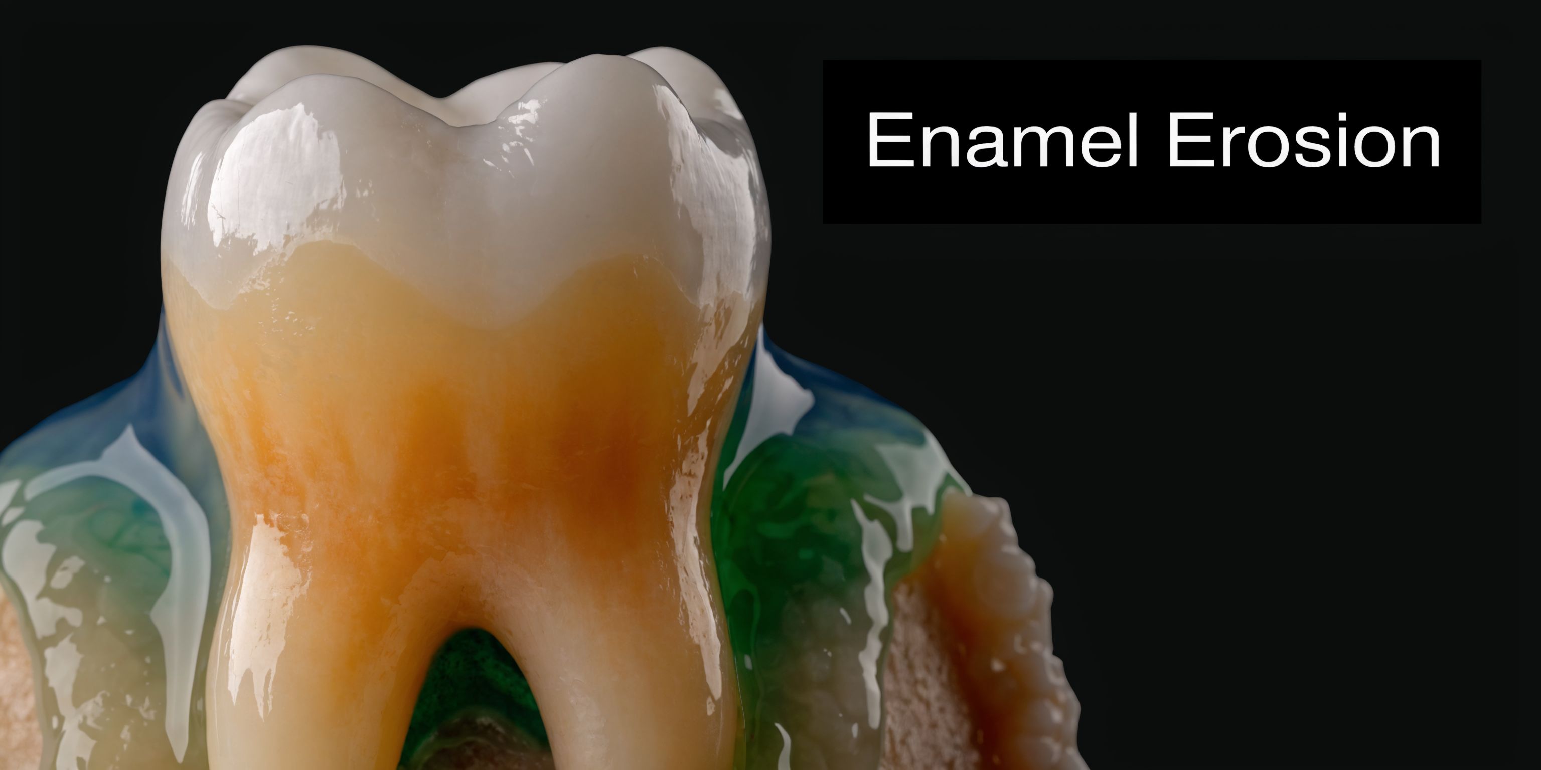 A close-up illustration showing a molar tooth with enamel erosion and sensitive, exposed dentin structure.