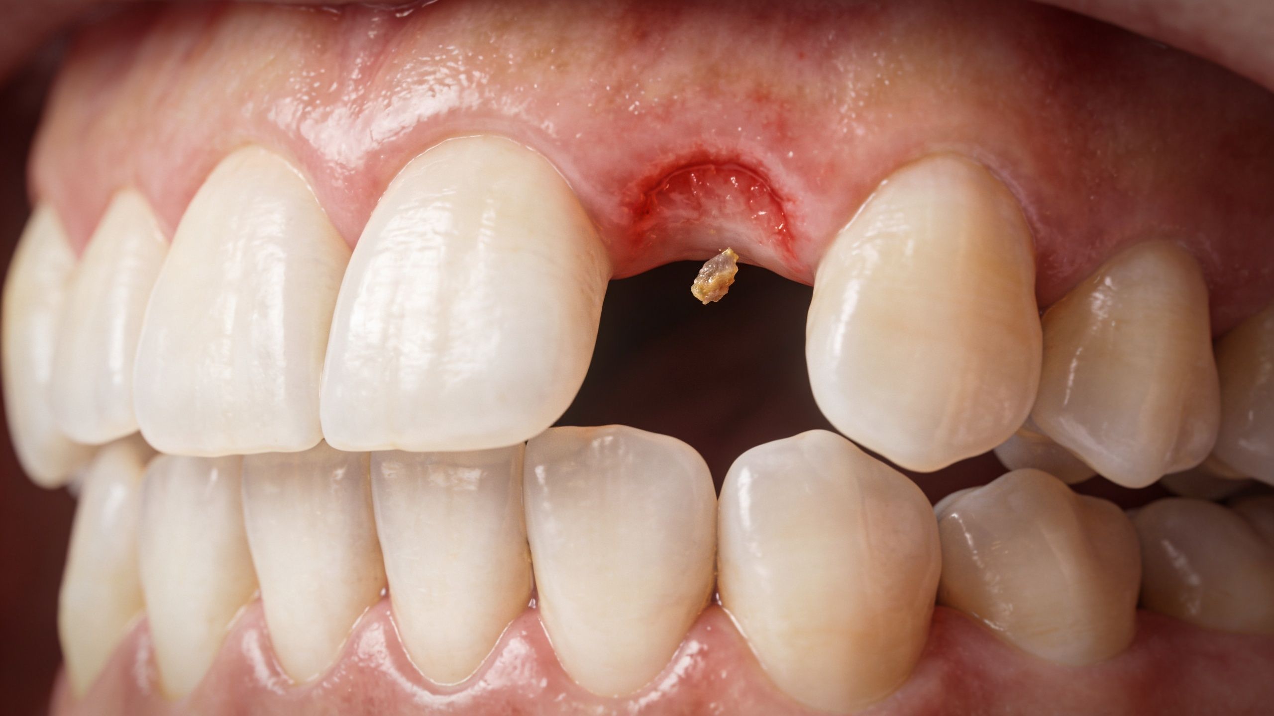 A close-up view of a dental gap between front teeth with visible gum inflammation and debris.