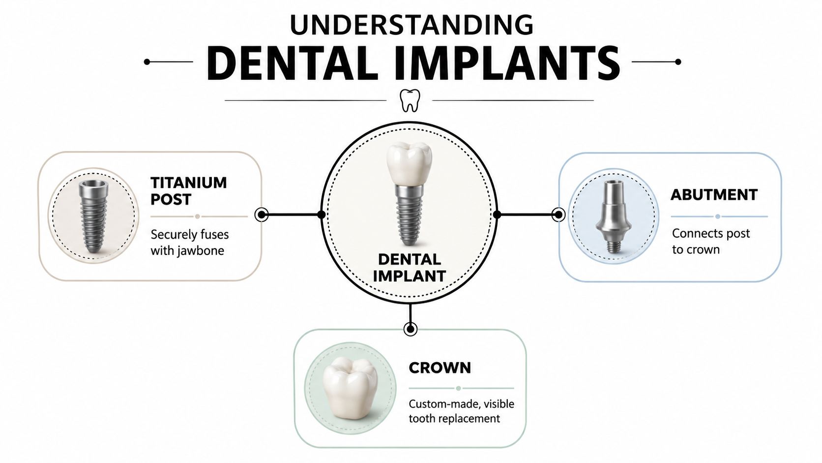 A diagram illustrating the three main components of a dental implant: titanium post, abutment, and crown.