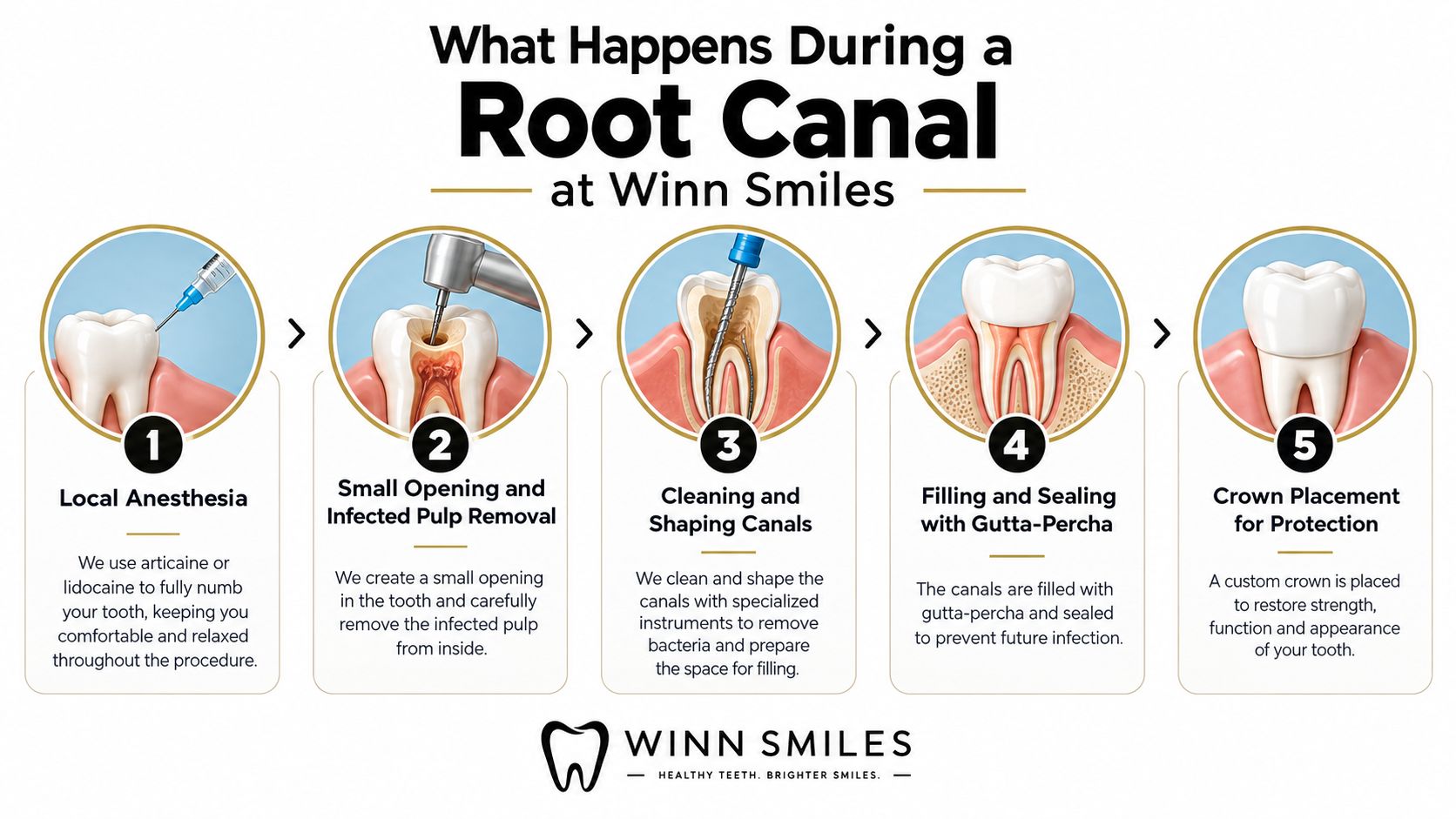 A step-by-step infographic showing the five stages of a root canal procedure at Winn Smiles dentistry.