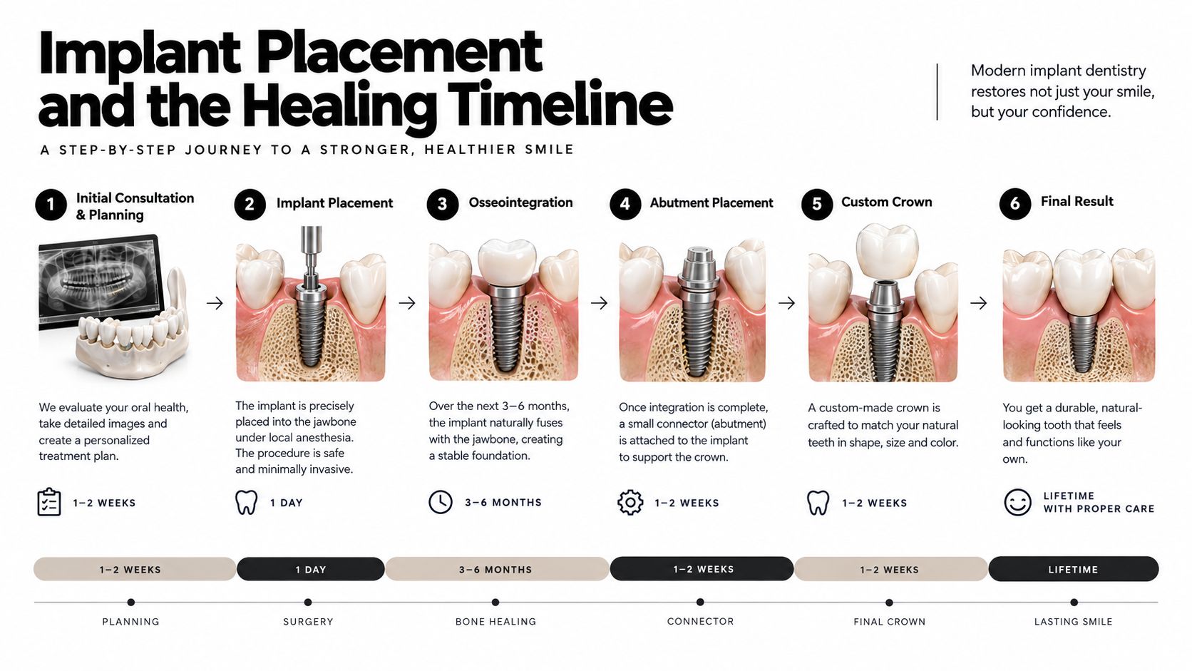 A step-by-step infographic showing the six stages of dental implant placement, from initial consultation to final results.