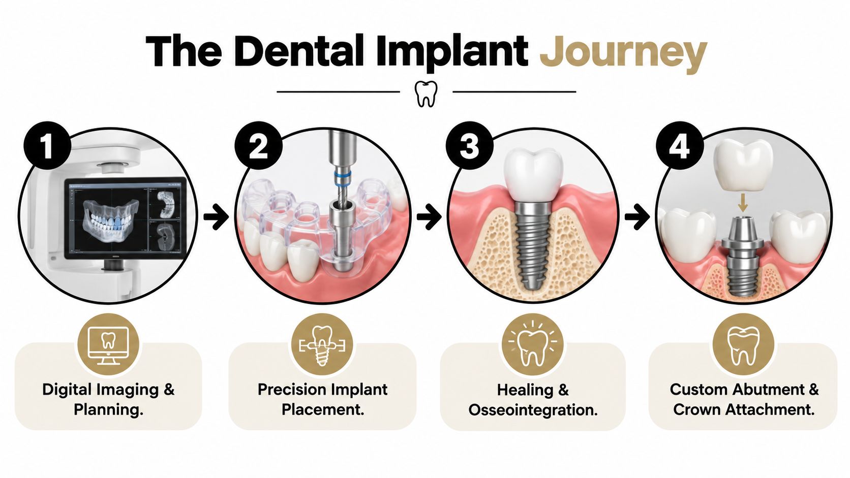 A diagram illustrating the four-step dental implant process, including digital planning, placement, healing, and final crown attachment.