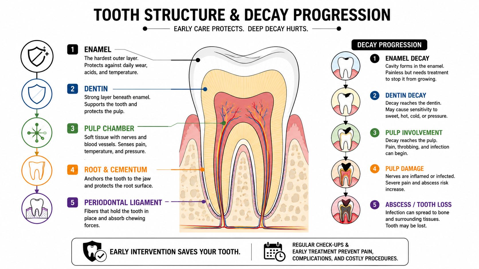 A diagram illustrating tooth structure components and the progressive stages of dental decay from enamel to abscess.