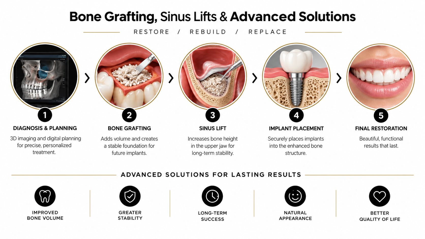 A five-step infographic showing the dental bone grafting, sinus lift, and implant placement process for restoring a smile.