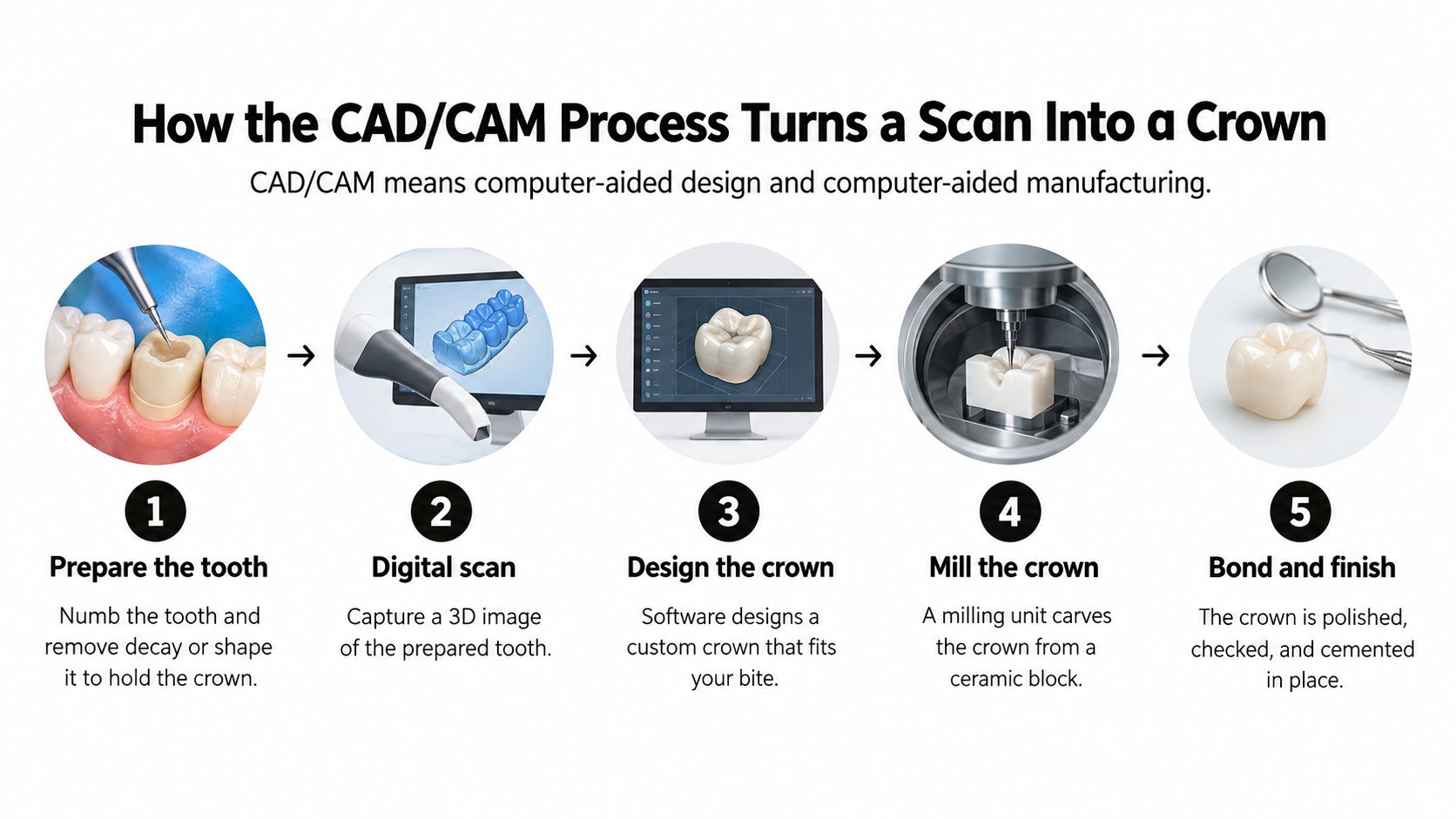 A five-step infographic showing the CAD/CAM process for creating a dental crown from scan to final bonding.
