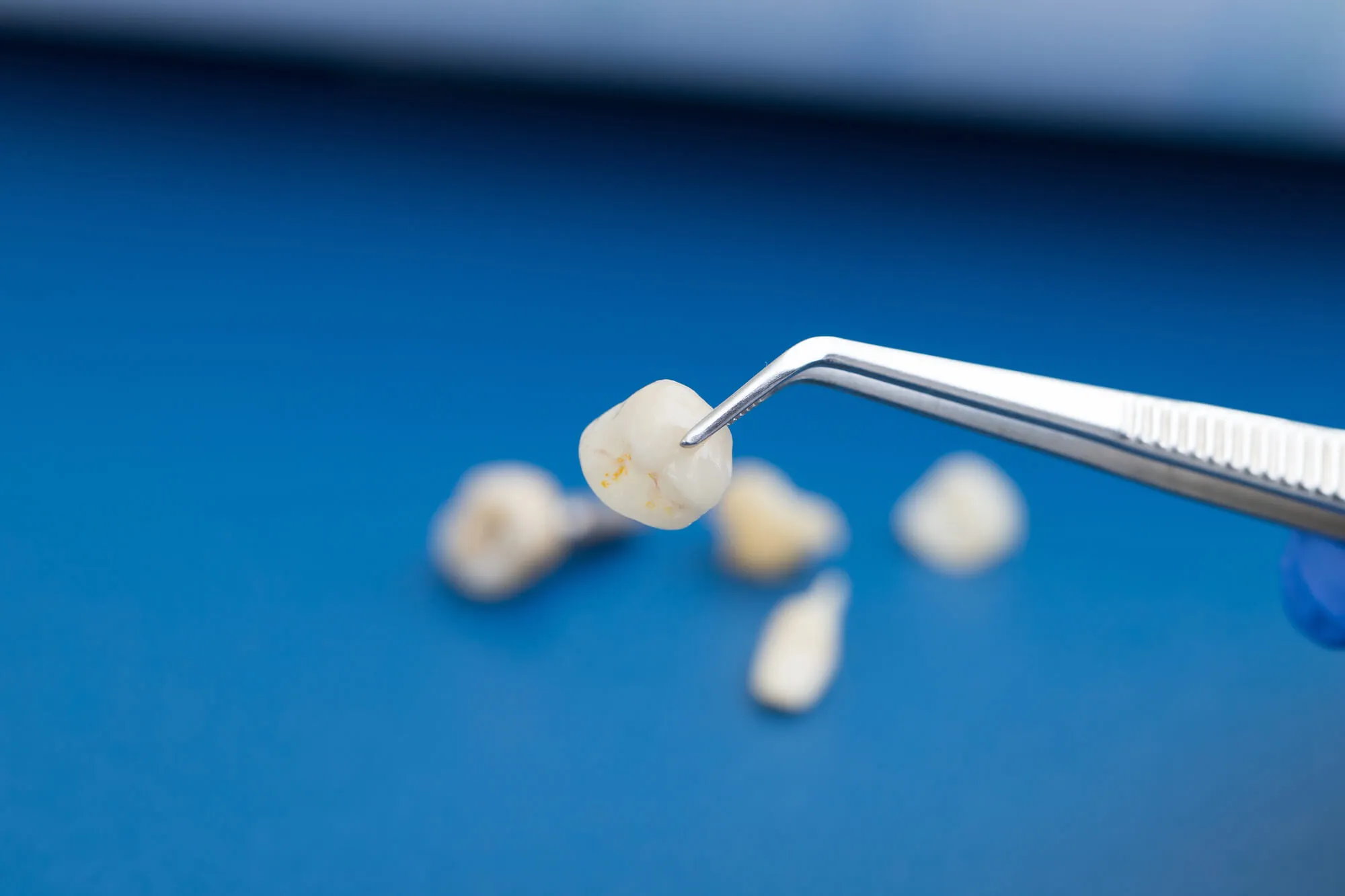 cosmetic dentist birmingham al inspects a veneer