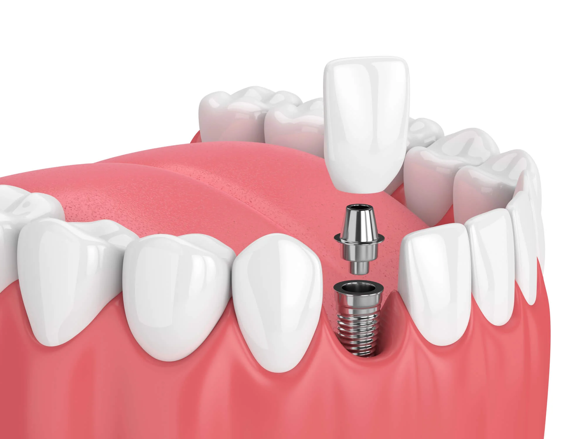 3D illustration of affordable dental implants in Trussville, AL.