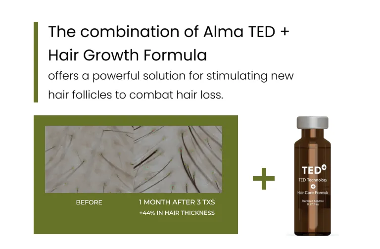 A image about Alma TED Hair Restoration