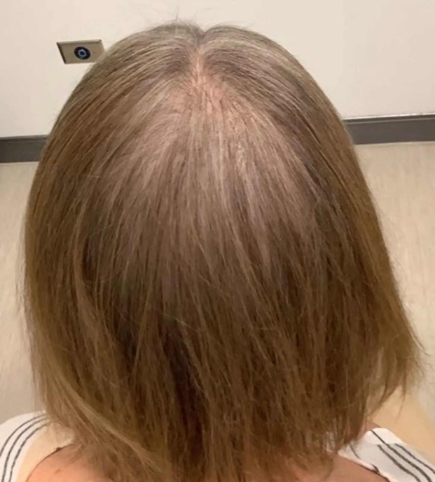 A woman with hair loss before Alma TED Hair Restoration