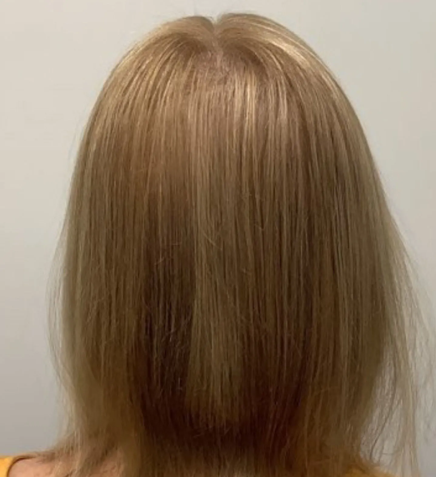 A woman's hair after getting Alma TED Hair Restoration