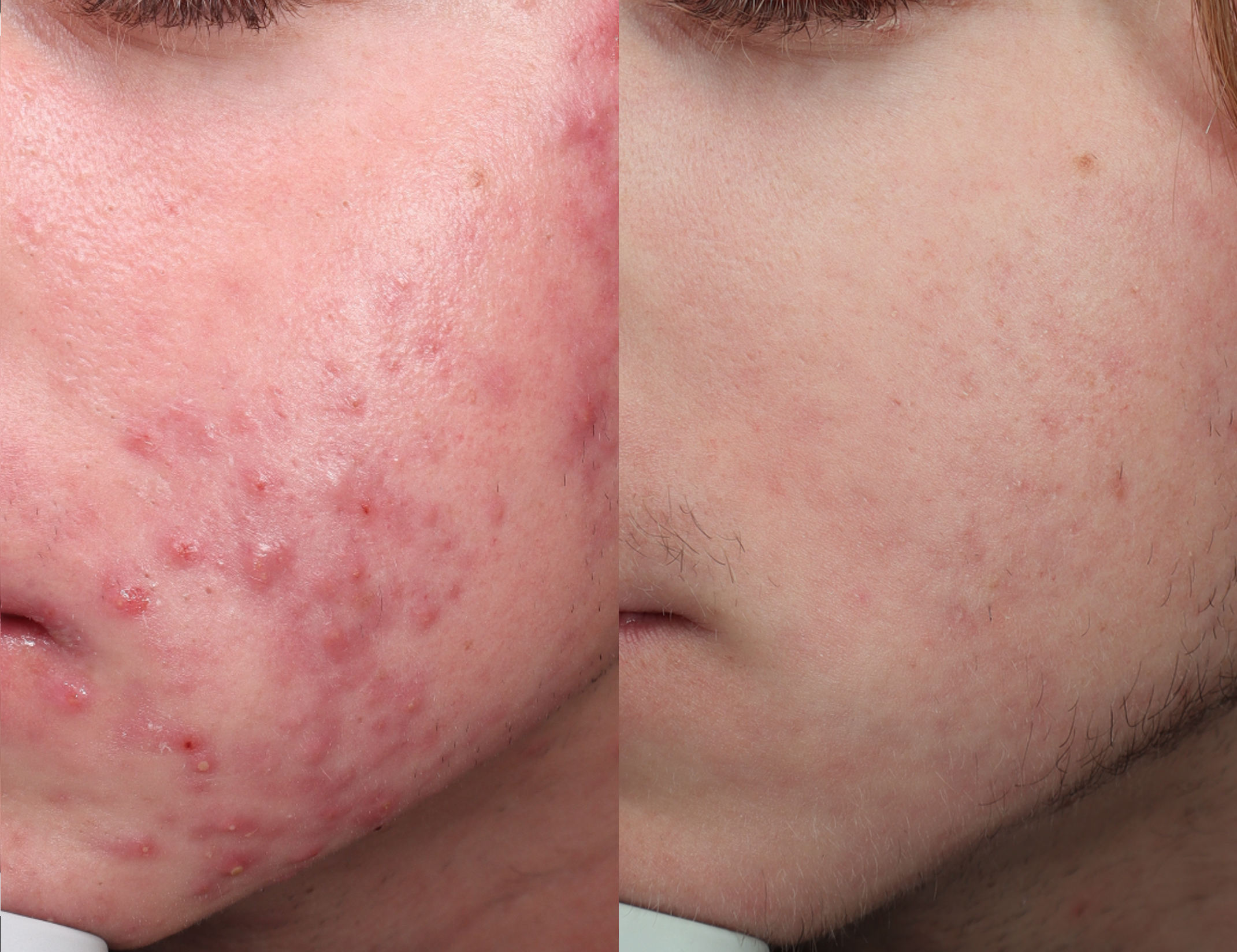 Real patient acne treatment results before and after laser skin resurfacing in San Diego