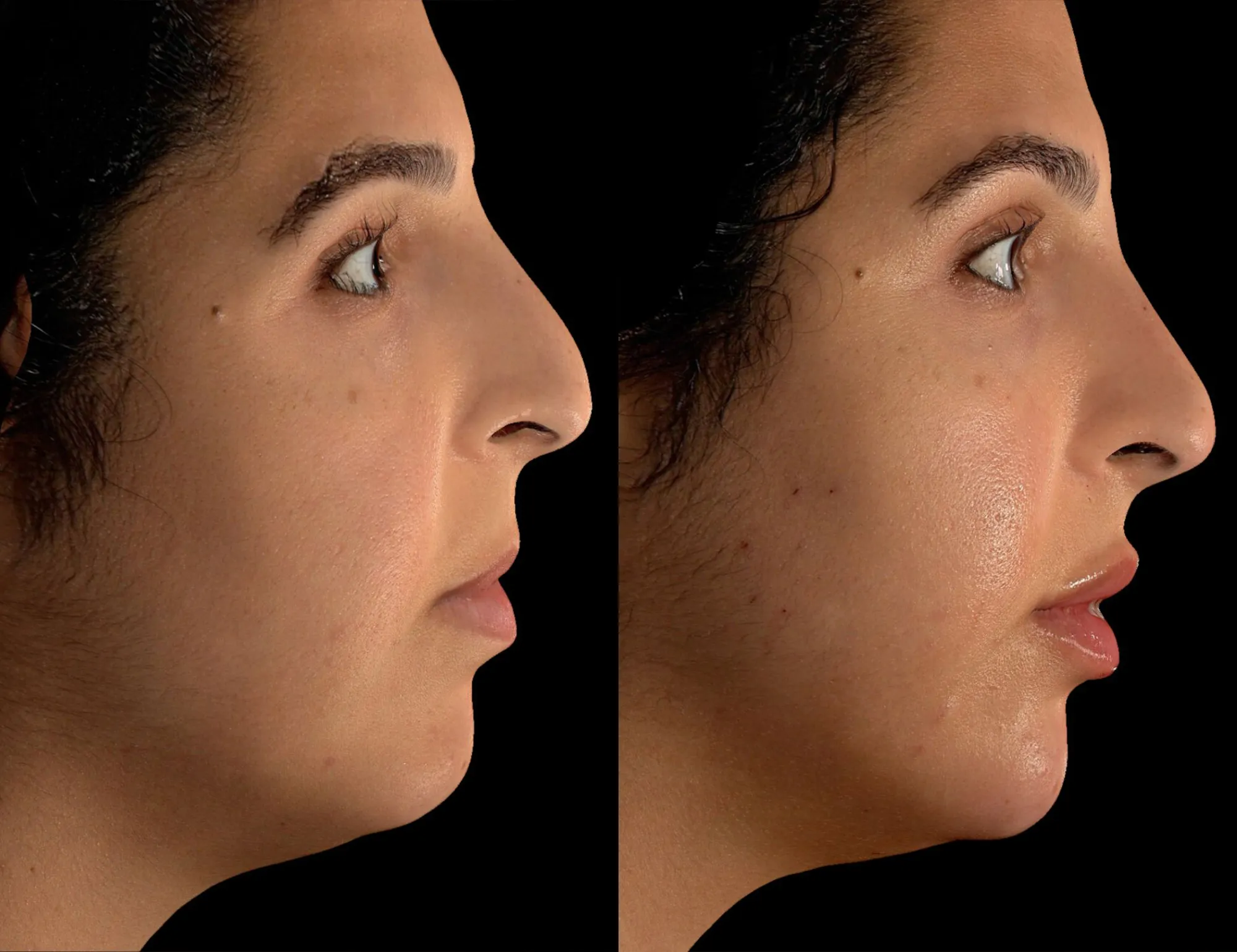 Female patient liquid rhinoplasty results in San Diego