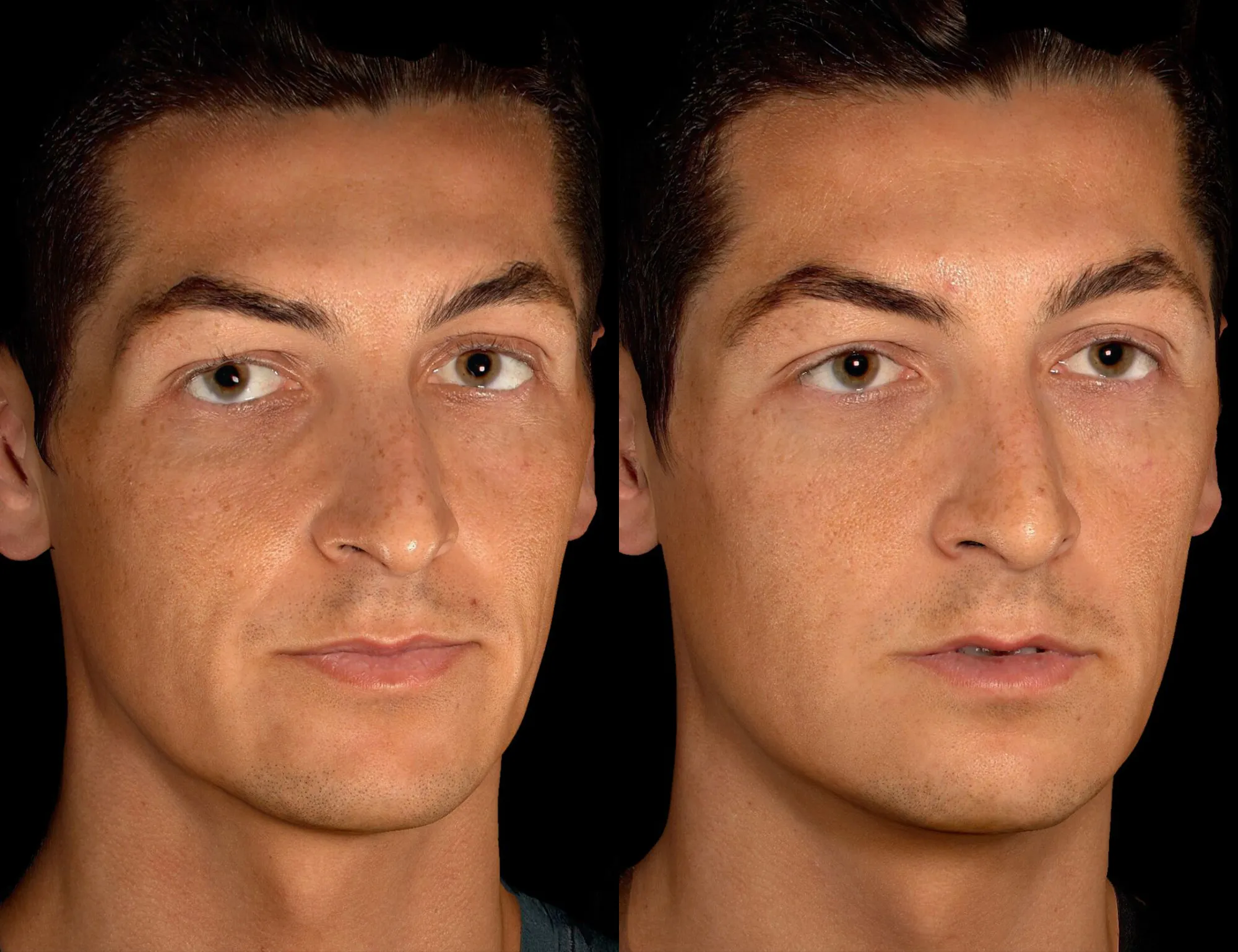 Male patient before and after brow, temple, and forehead filler in San Diego