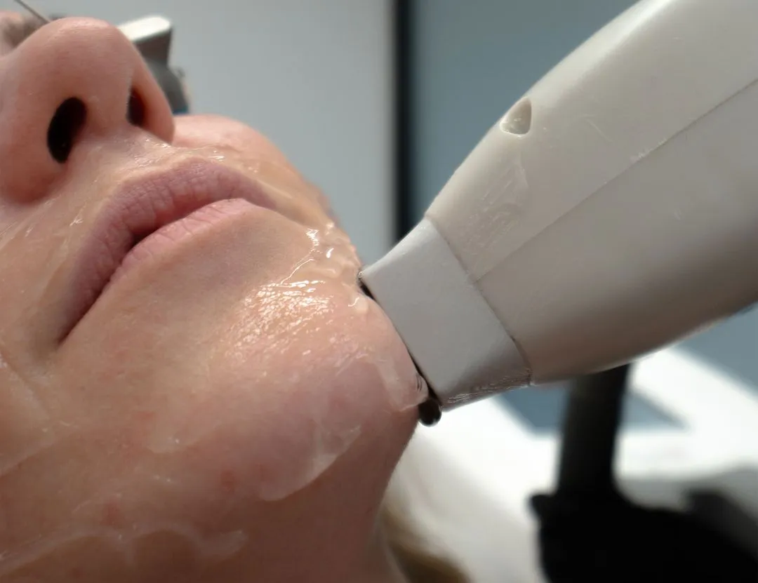 Patient in San Diego gets laser hair removal on face