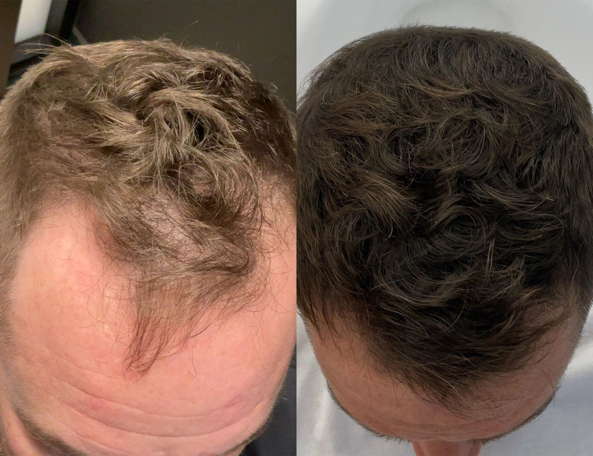 Top view of male patient before and after hair restoration in San Diego