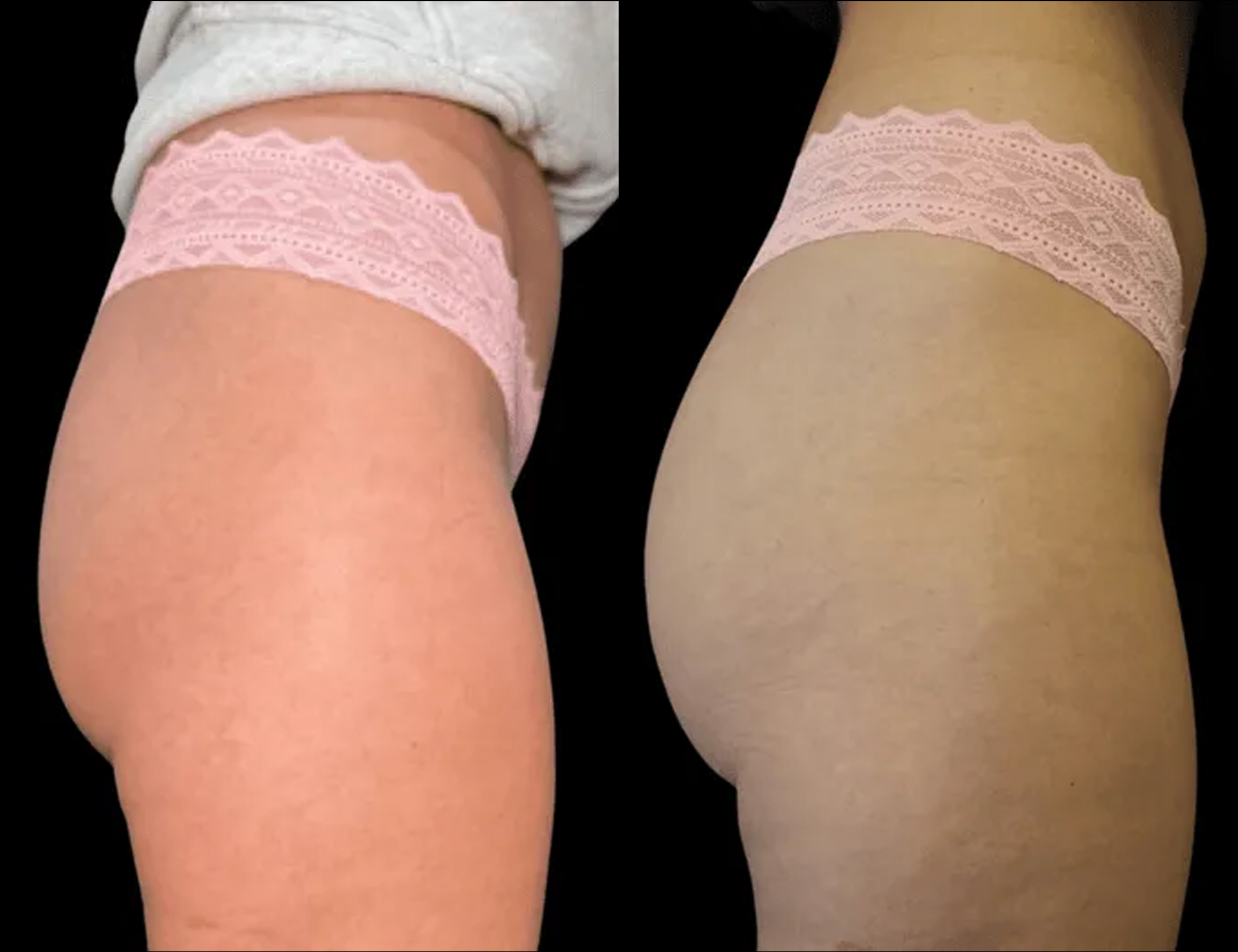 Female patient profile before and after liquid booty lift in San Diego