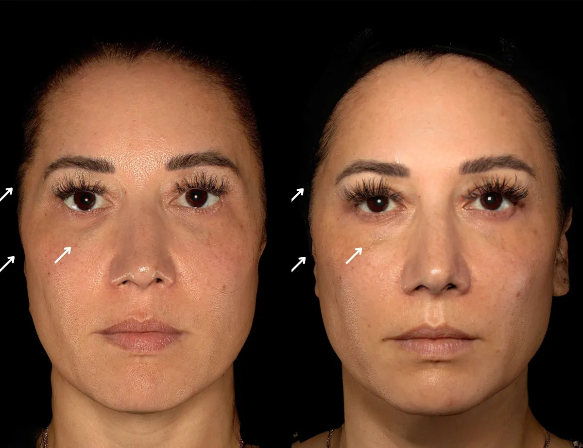 Female patient showing off results of filler dissolution in San Diego