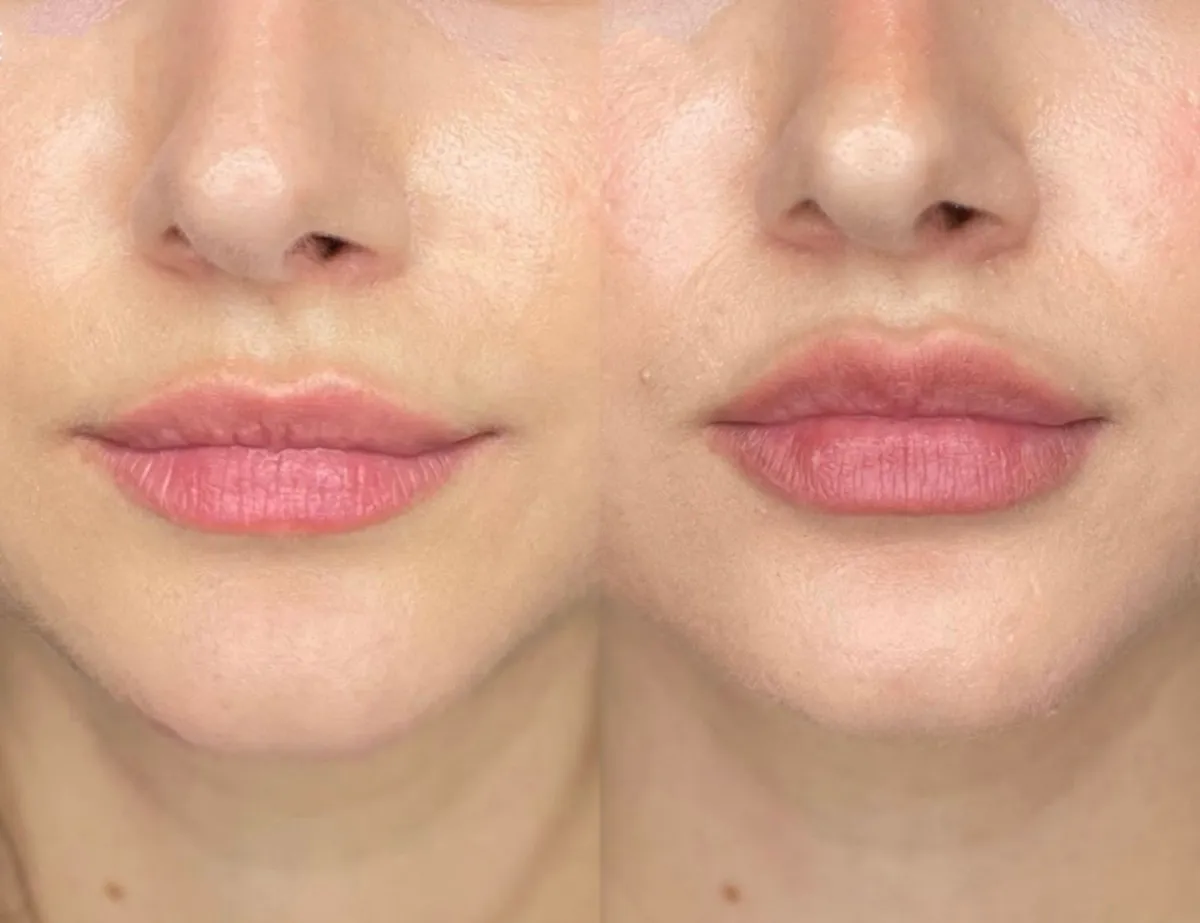 Close up shot of female patient results before and after lip flip in San DIego