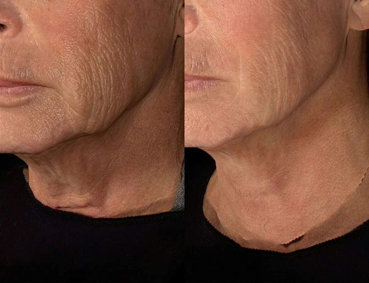 Before and after photos of a neck correction procedure