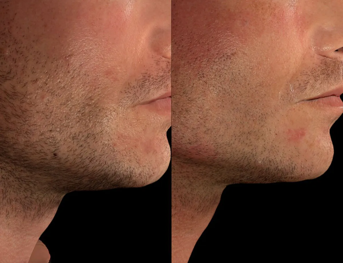 Male patient jawline following cheek, jawline, chin, and nasolabial fillers in San Diego 
