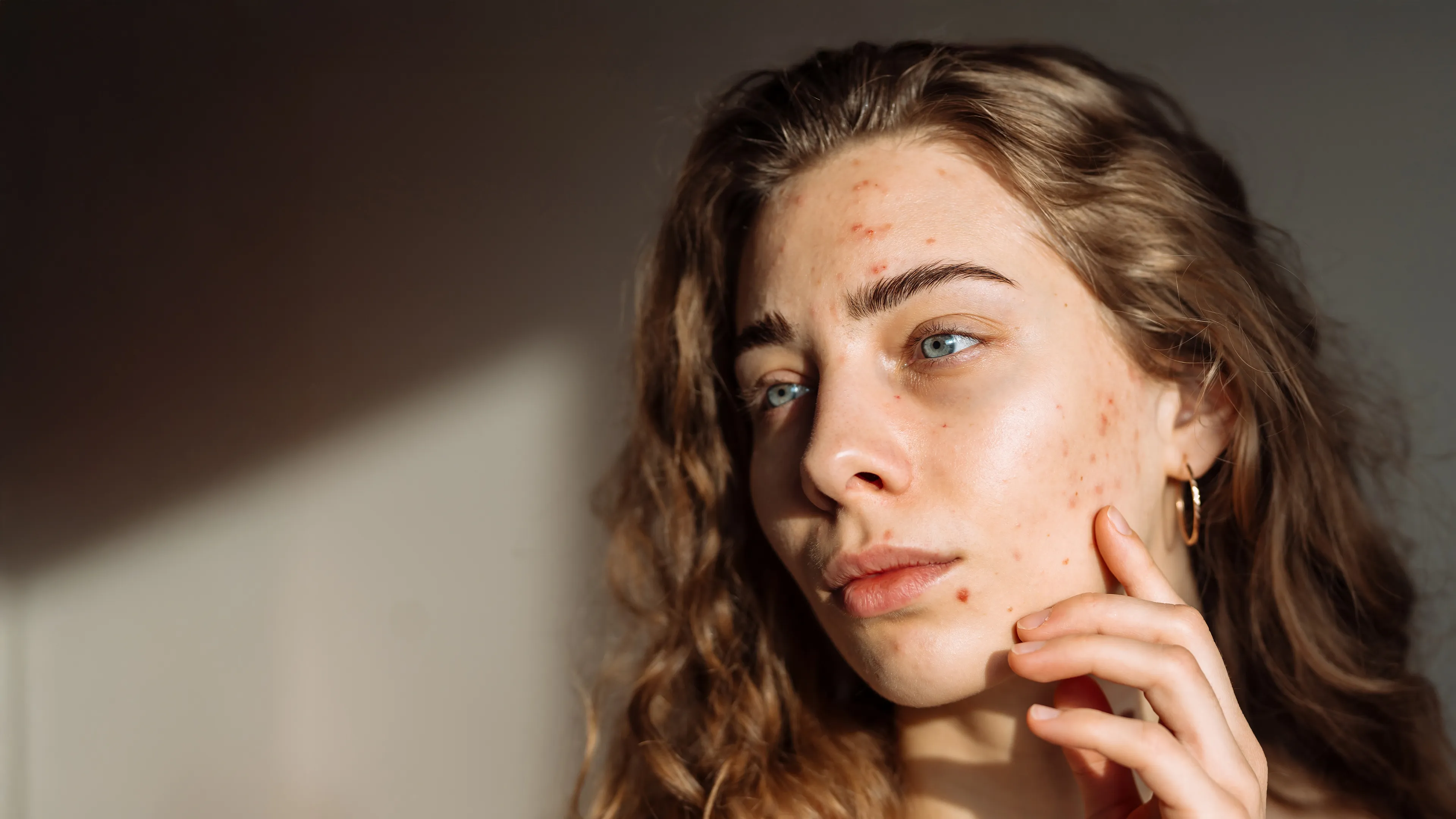 Acne Treatment in San Diego