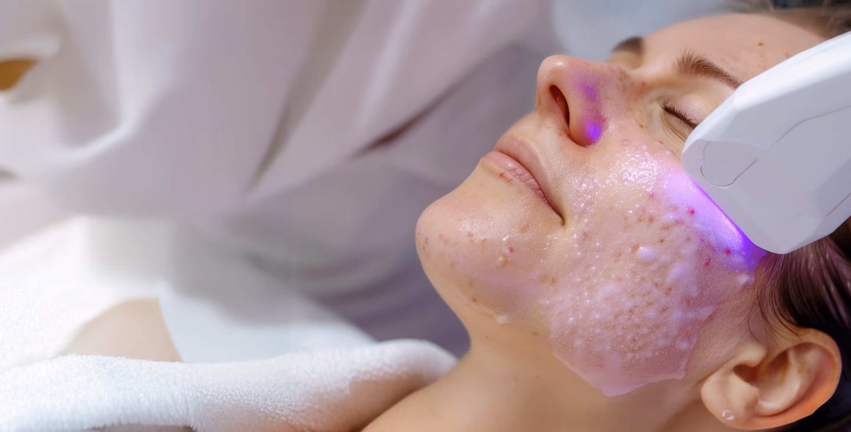 MicroLaser Peel Light Laser Resurfacing in San Diego