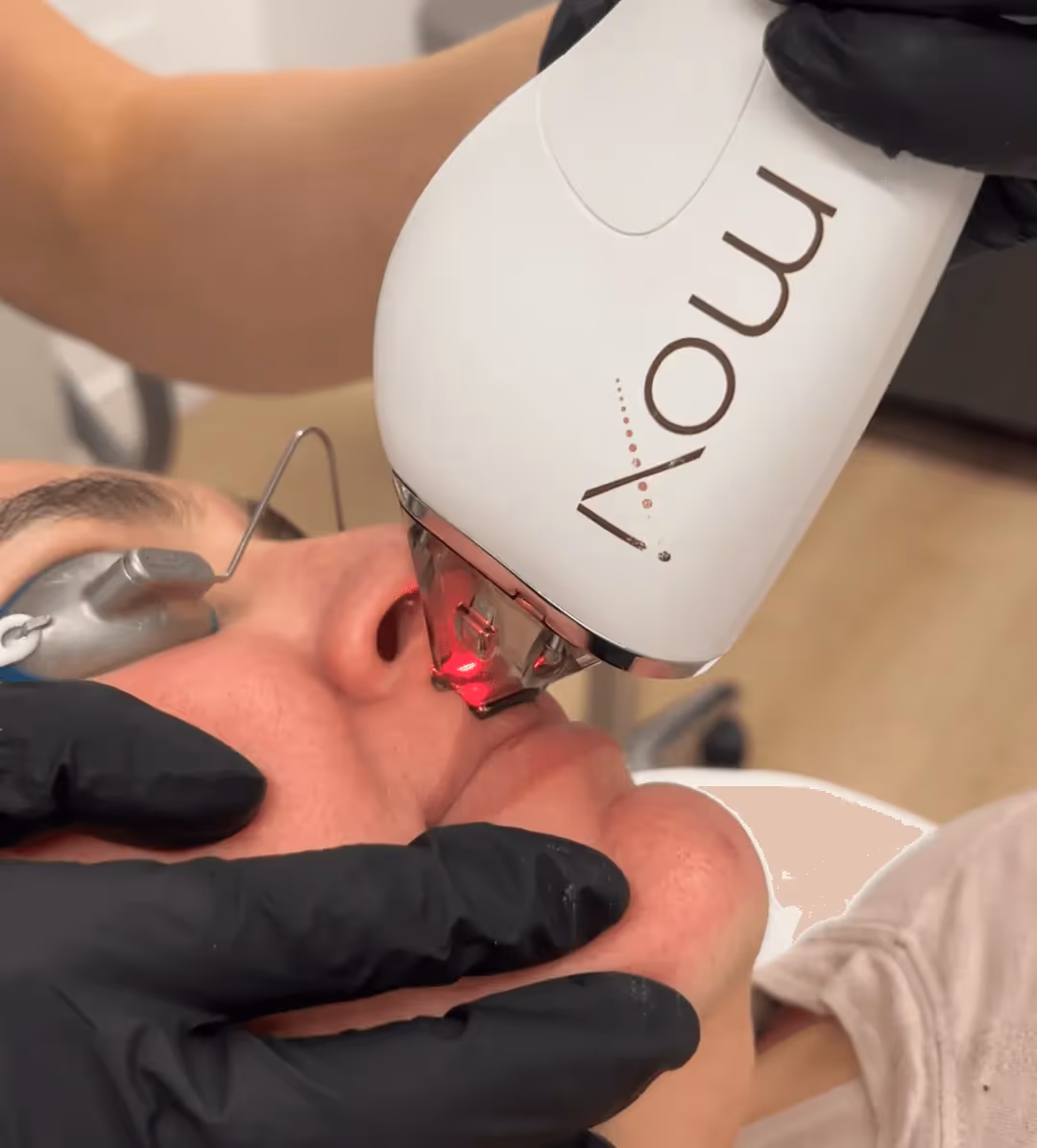 Patient receiving Moxi laser treatment in San Diego