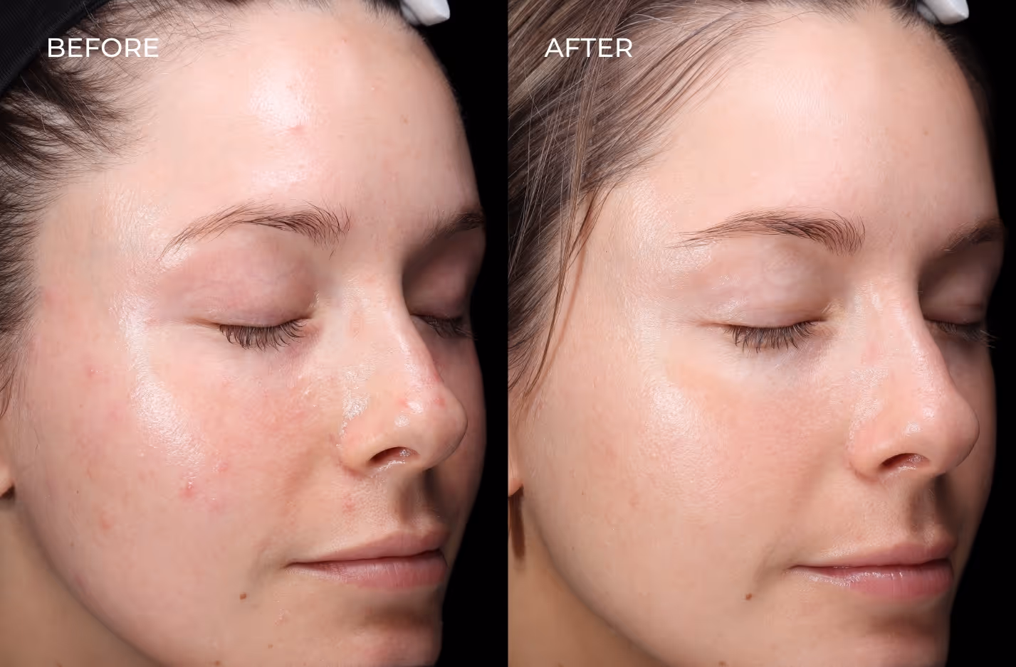 Before and after acne treatment in San Diego