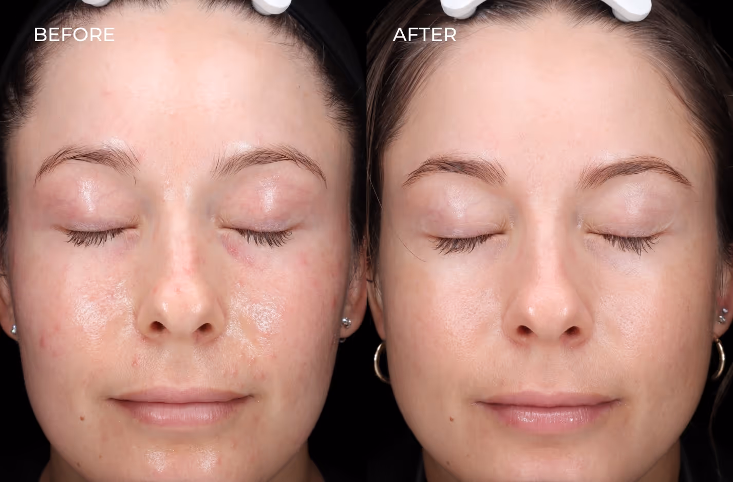 Frontal view of female patient's acne treatment results in San Diego