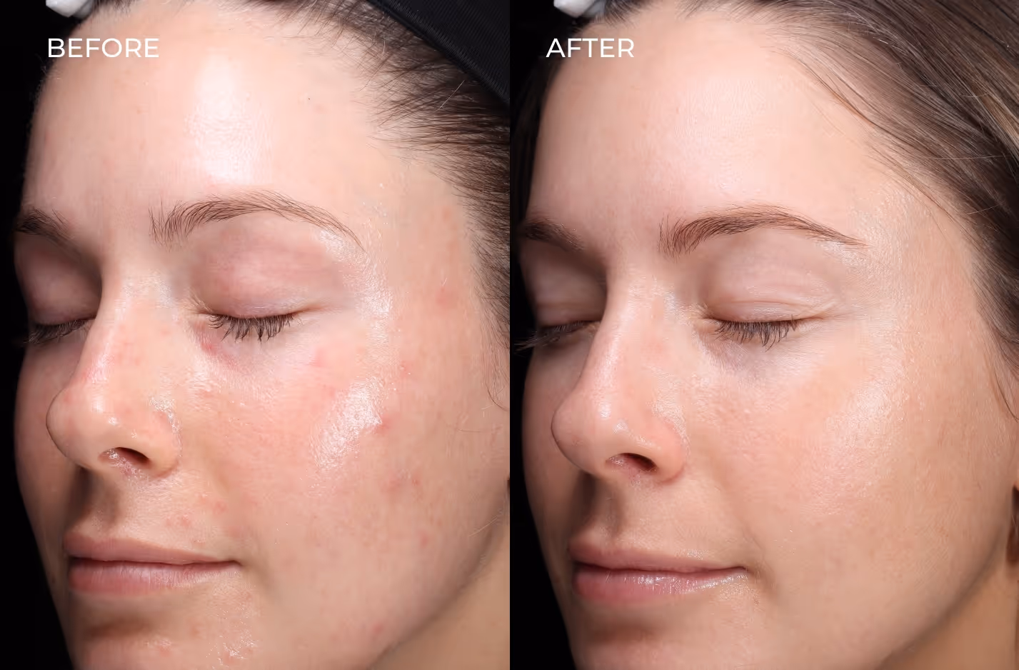 Female patient before and after acne treatment results in San Diego