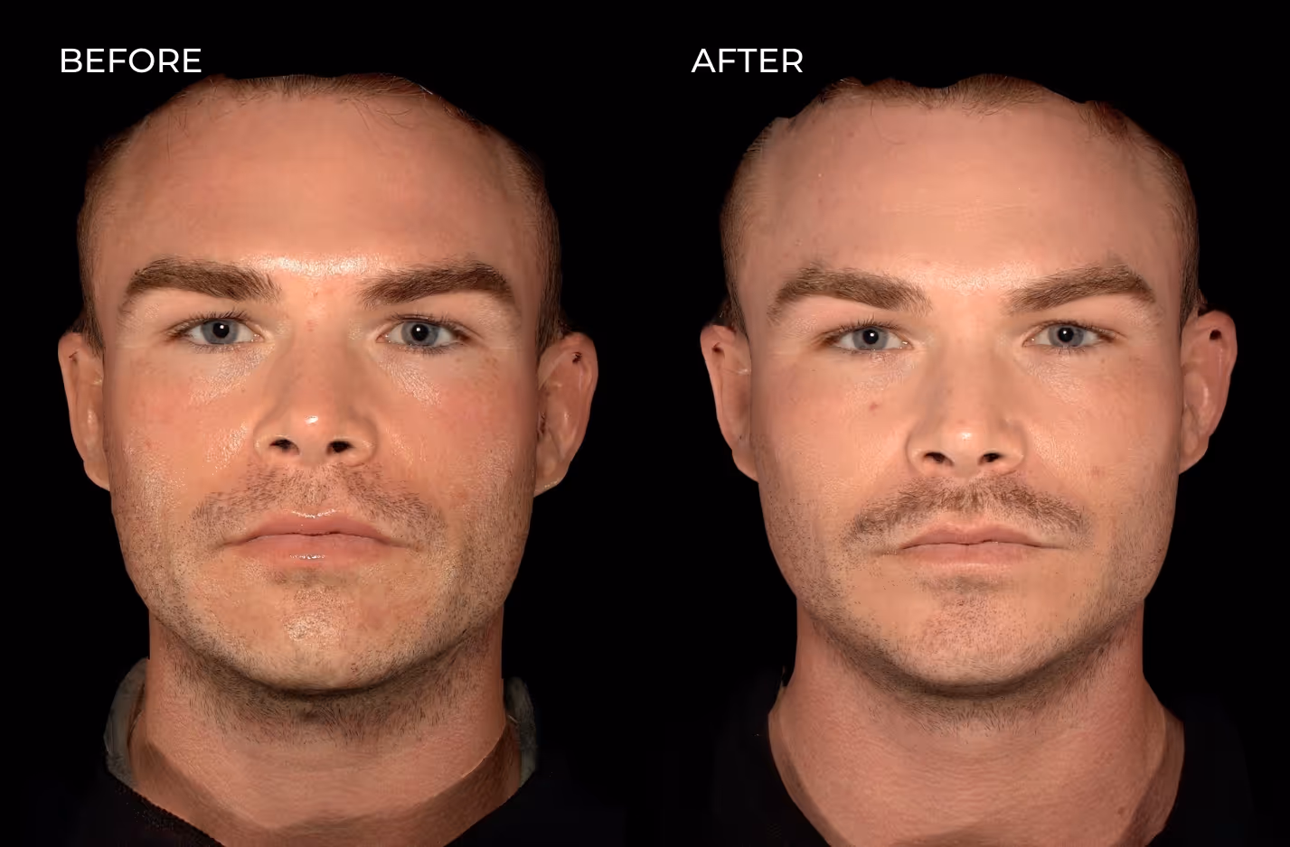Male patient showing off facial rebalancing results from dermal fillers in San Diego