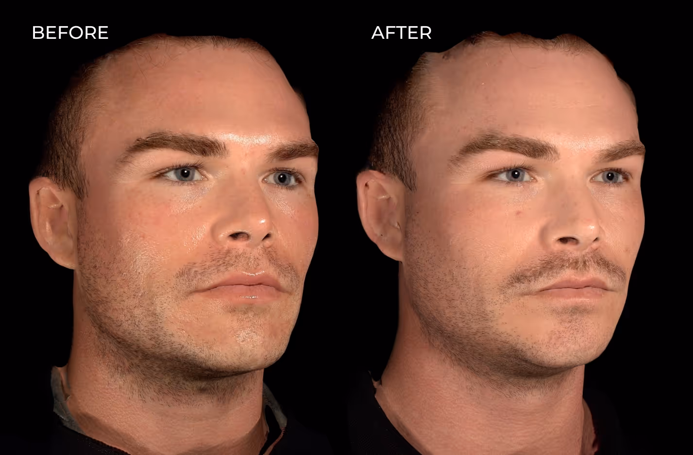 Male patient showing off facial rebalancing results from dermal fillers in San Diego