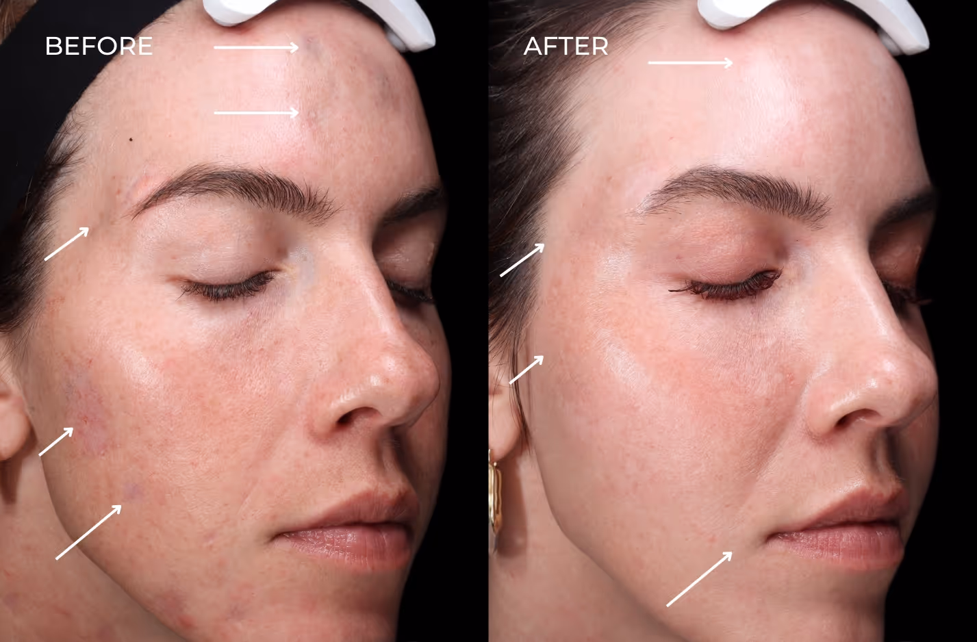 Female patient results before and after treatment with regenerative fillers in San Diego