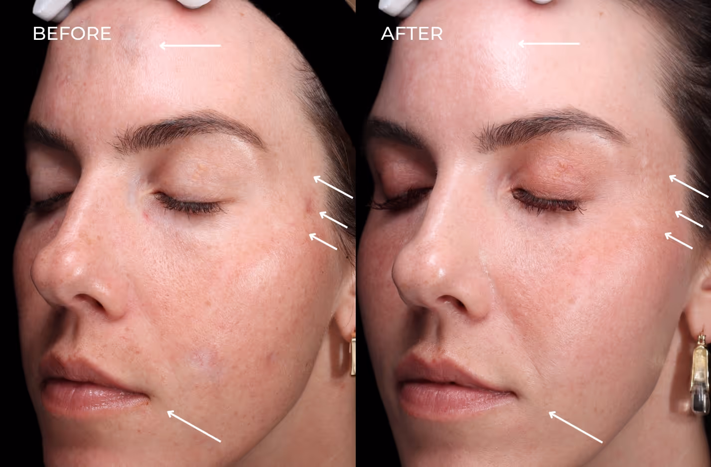 Female patient results before and after treatment with regenerative fillers in San Diego