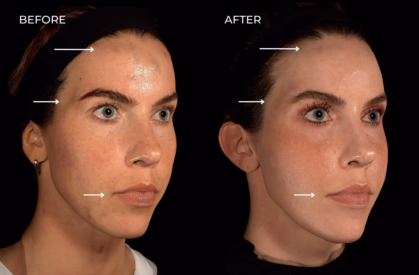 Female patient before and after treatment with regenerative fillers like Sculptra in San Diego