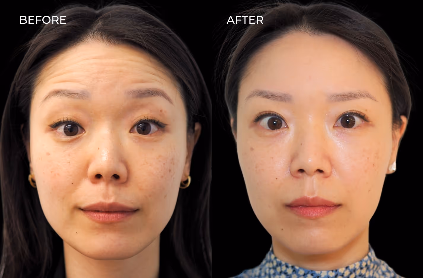 Frontal view of female patient before and after Botox in San Diego