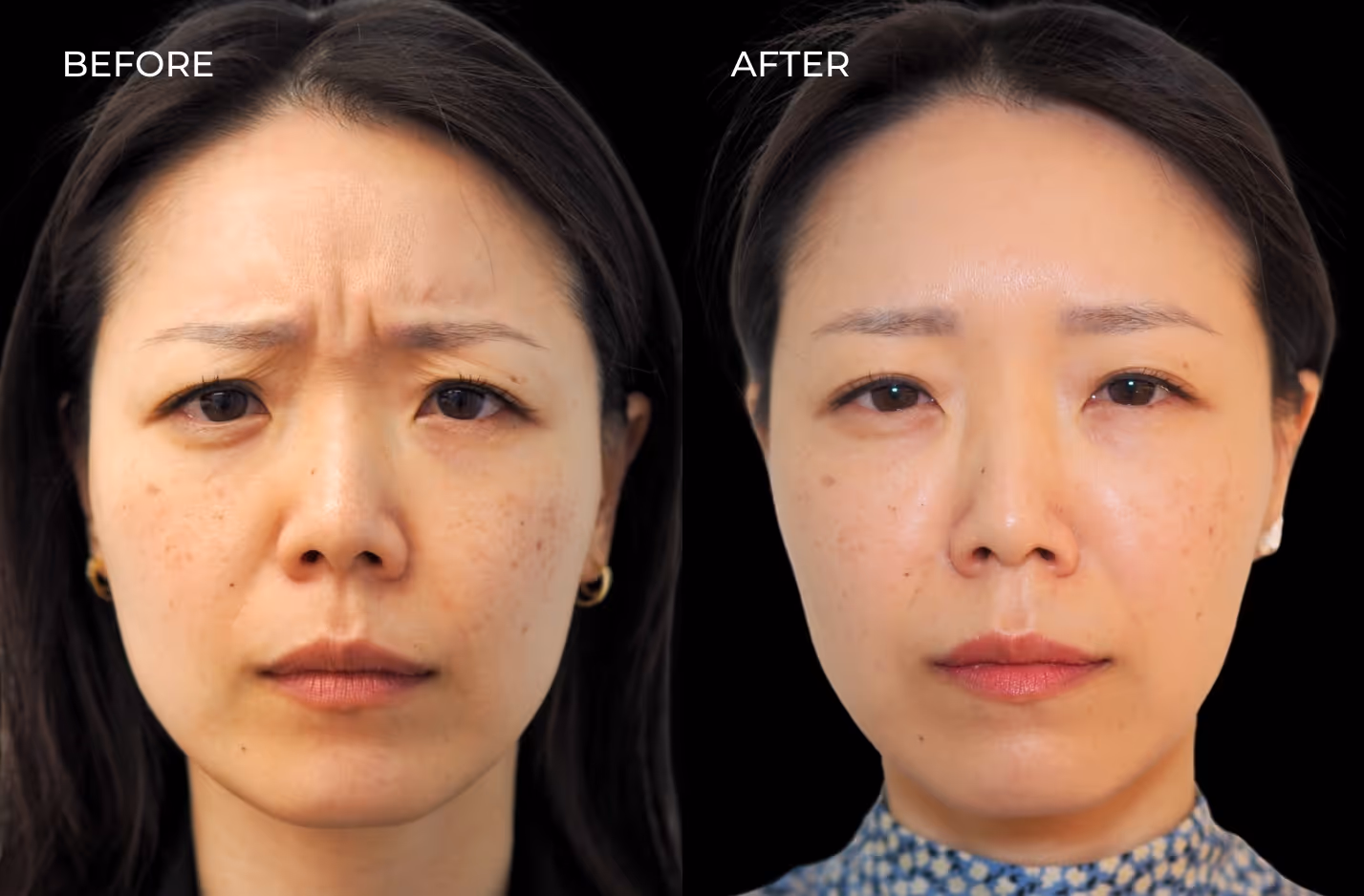 Frontal view of female patient before and after Botox in San Diego