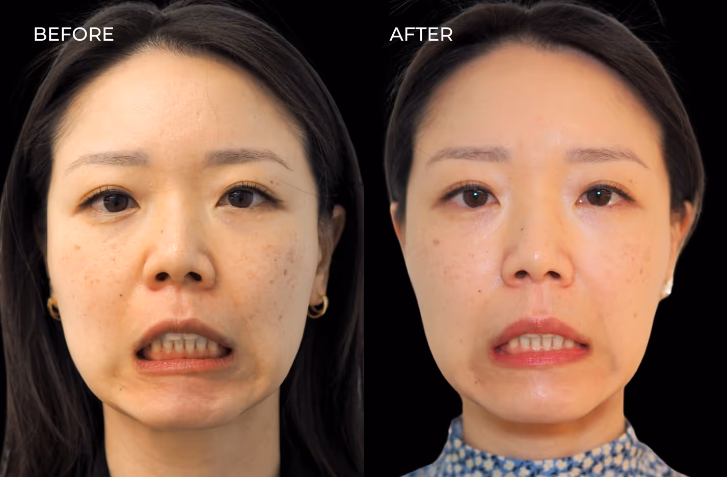 Frontal view of female patient before and after Botox in San Diego