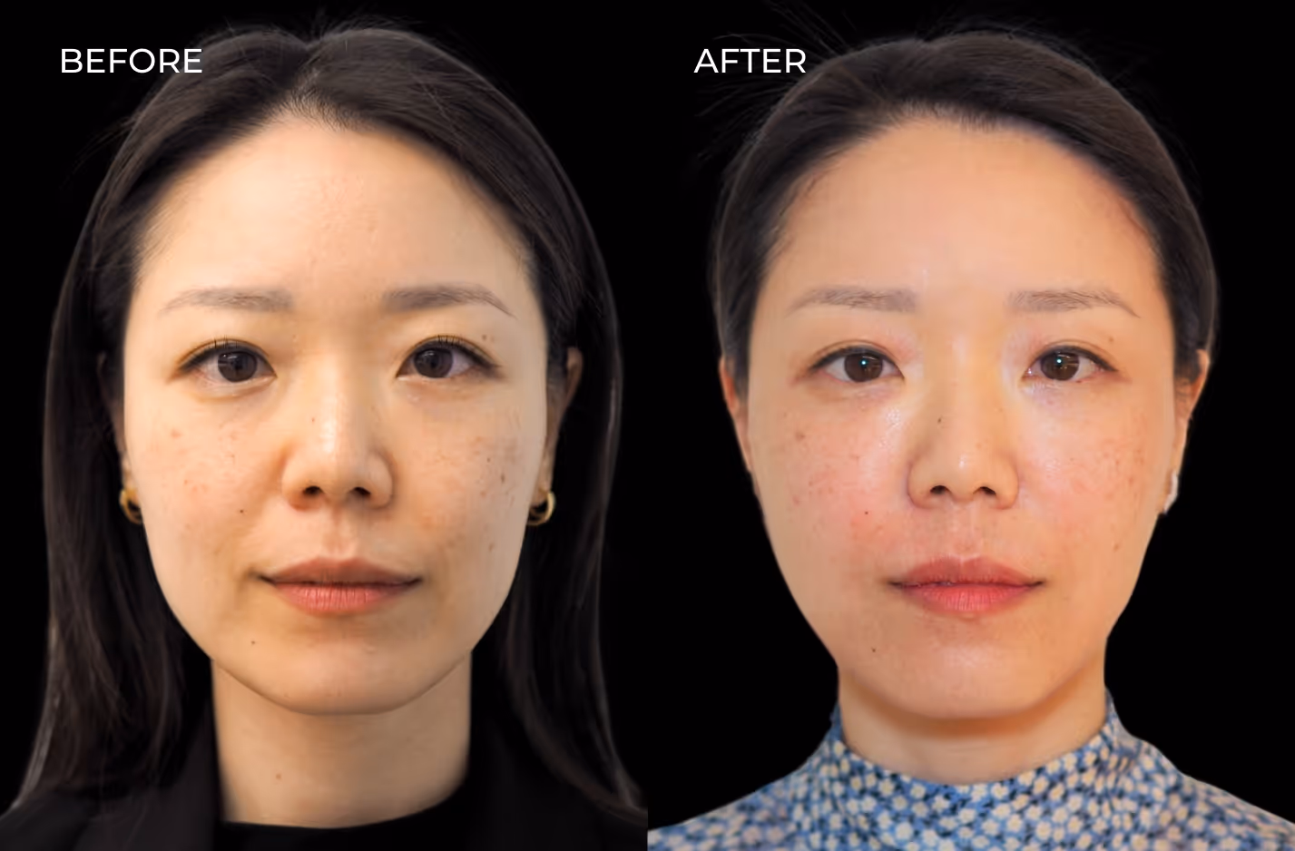 Frontal view of female patient before and after Botox in San Diego