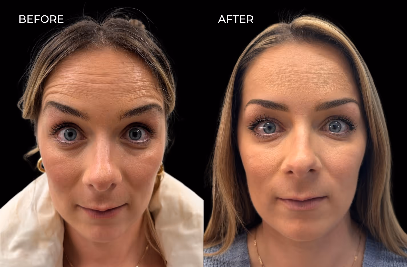Botox before and after photos