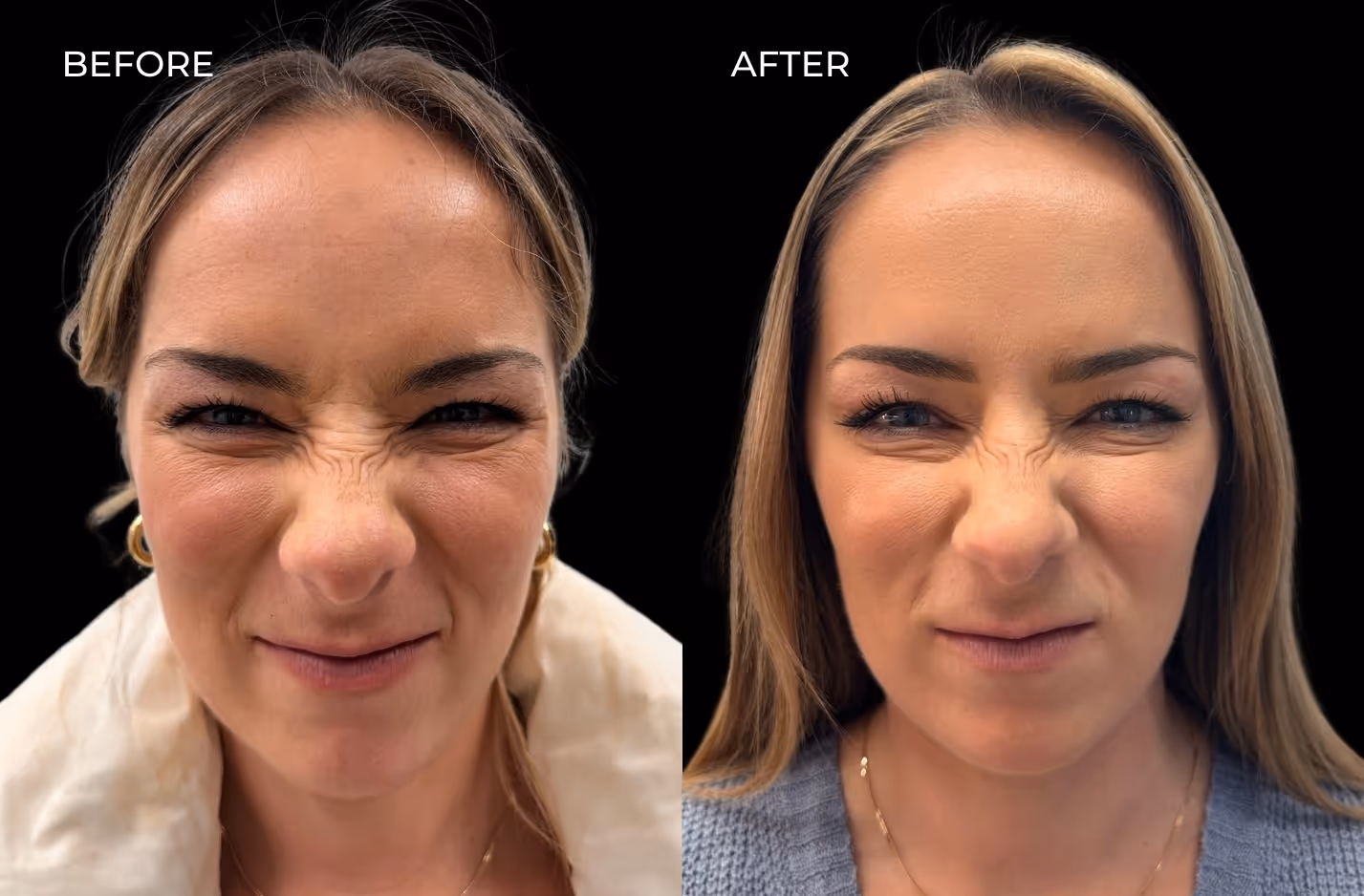 Frontal view of female patient's botox results in San Diego