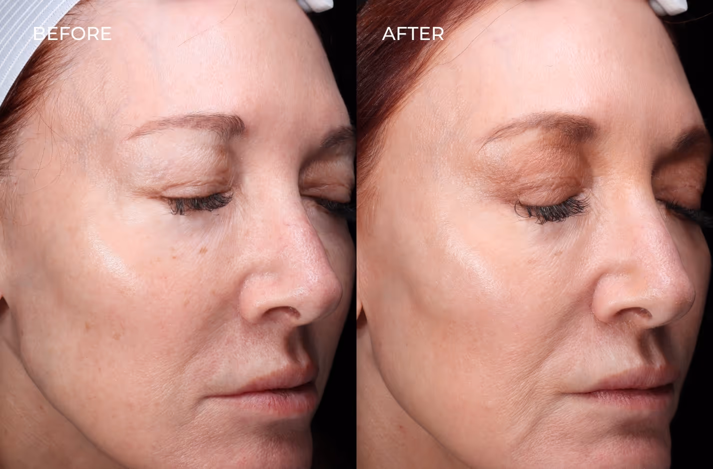 Female patient before and after a variety of treatments including Botox and dermal fillers in San Diego