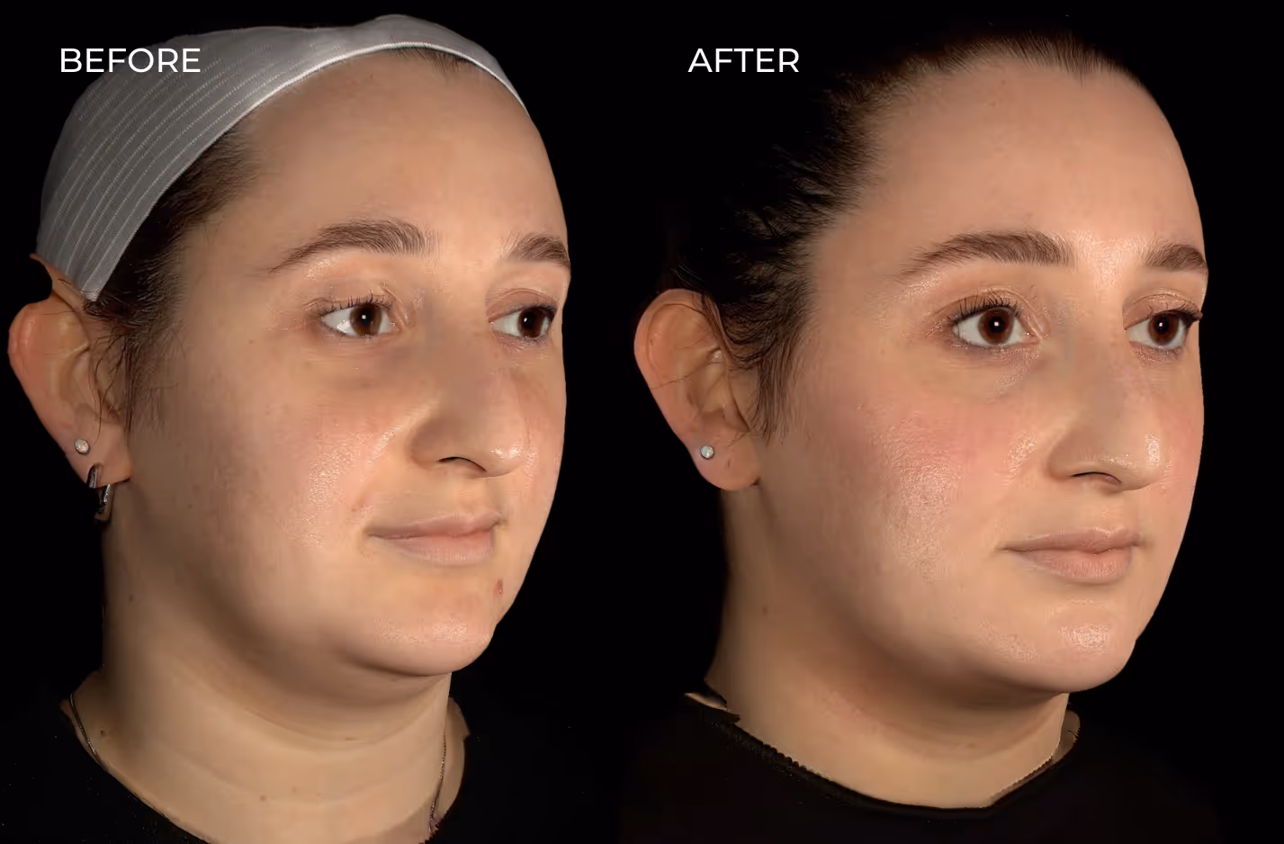 Female patient rf microneedling and Botox results in San Diego