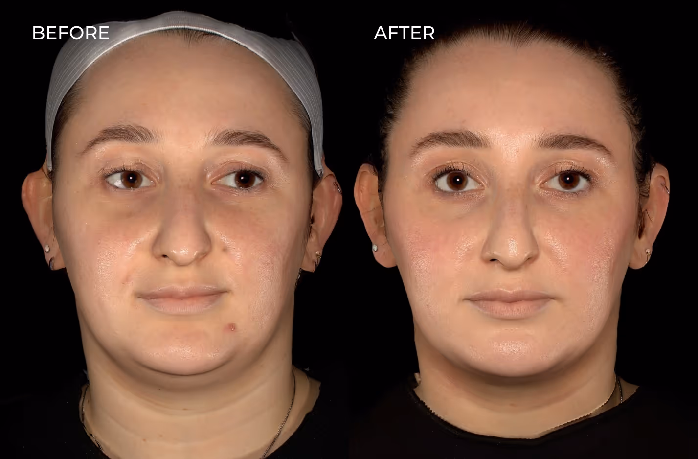 Female patient rf microneedling and Botox results in San Diego