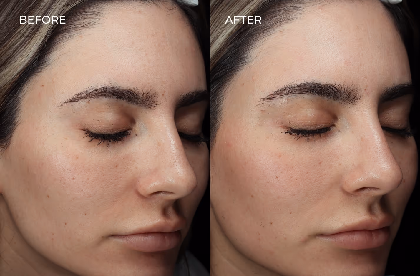 Side view of female patients face before and after fillers in San Diego
