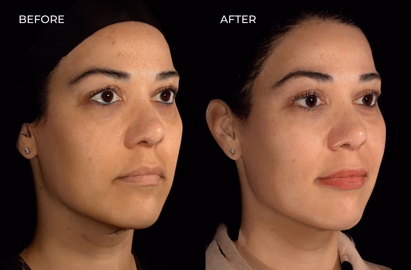 Patient showcasing filler results before and after treatment in san diego