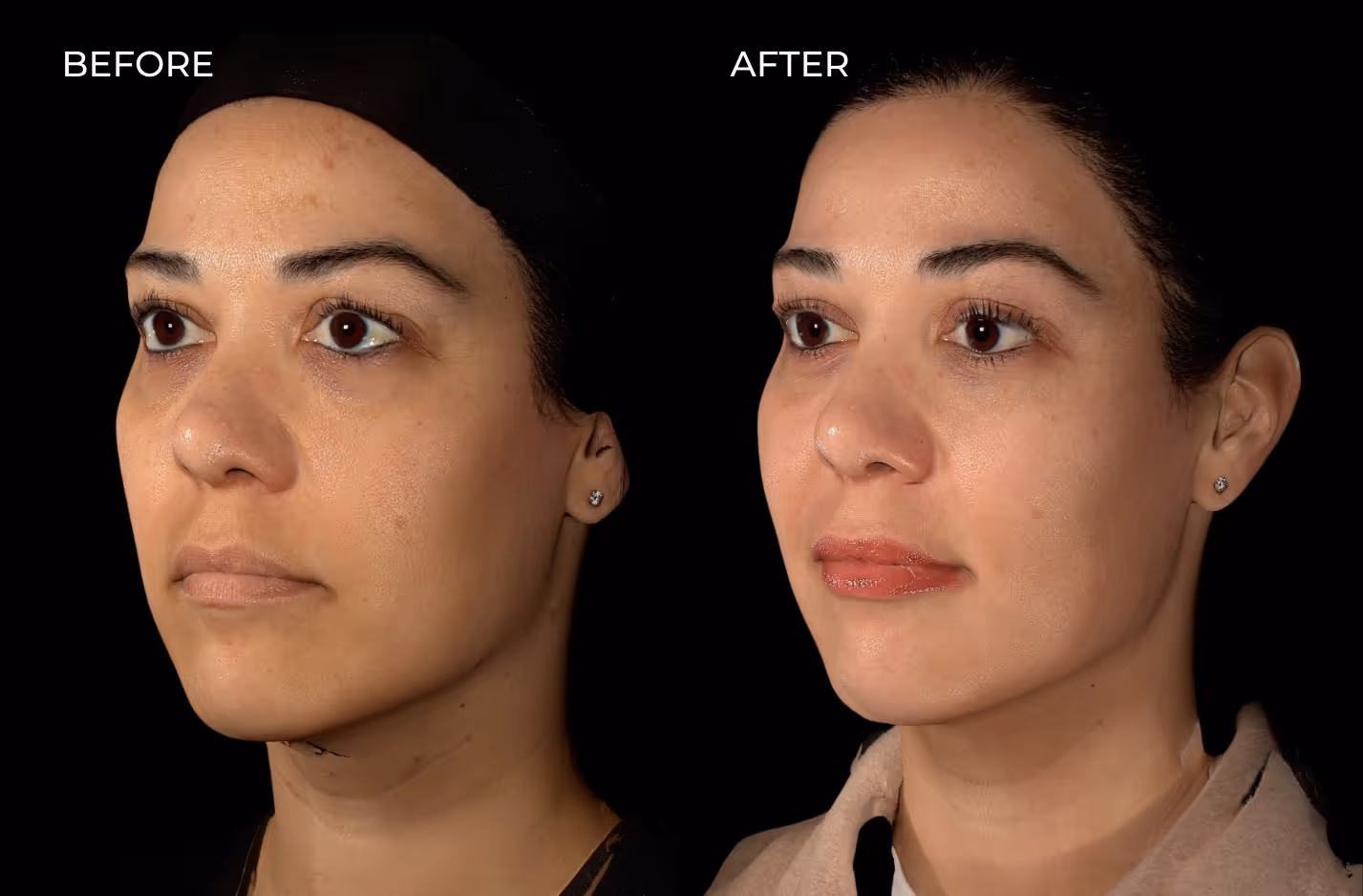Patient showcasing filler results before and after treatment in san diego