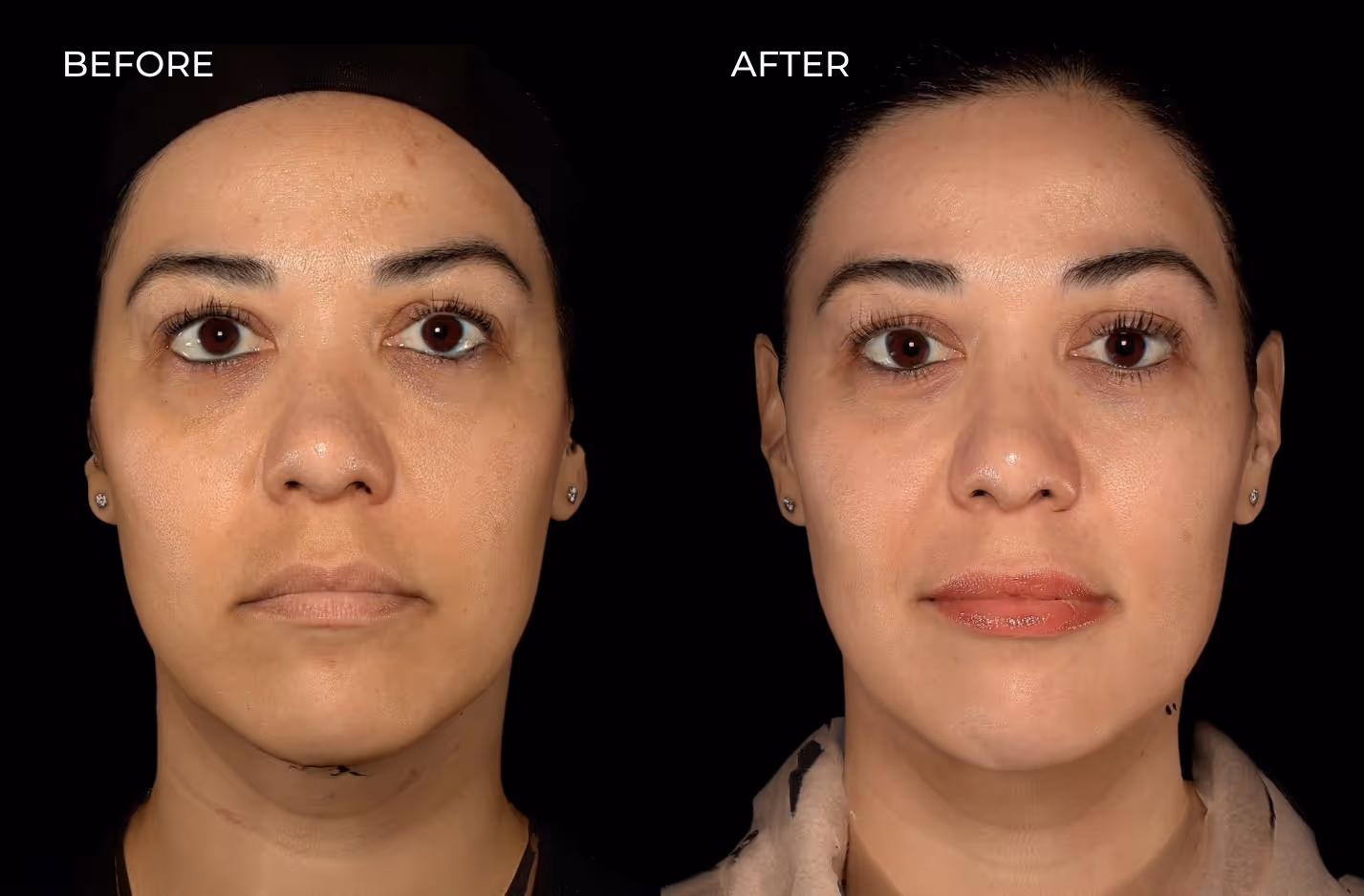 Patient showcasing filler results before and after treatment in san diego