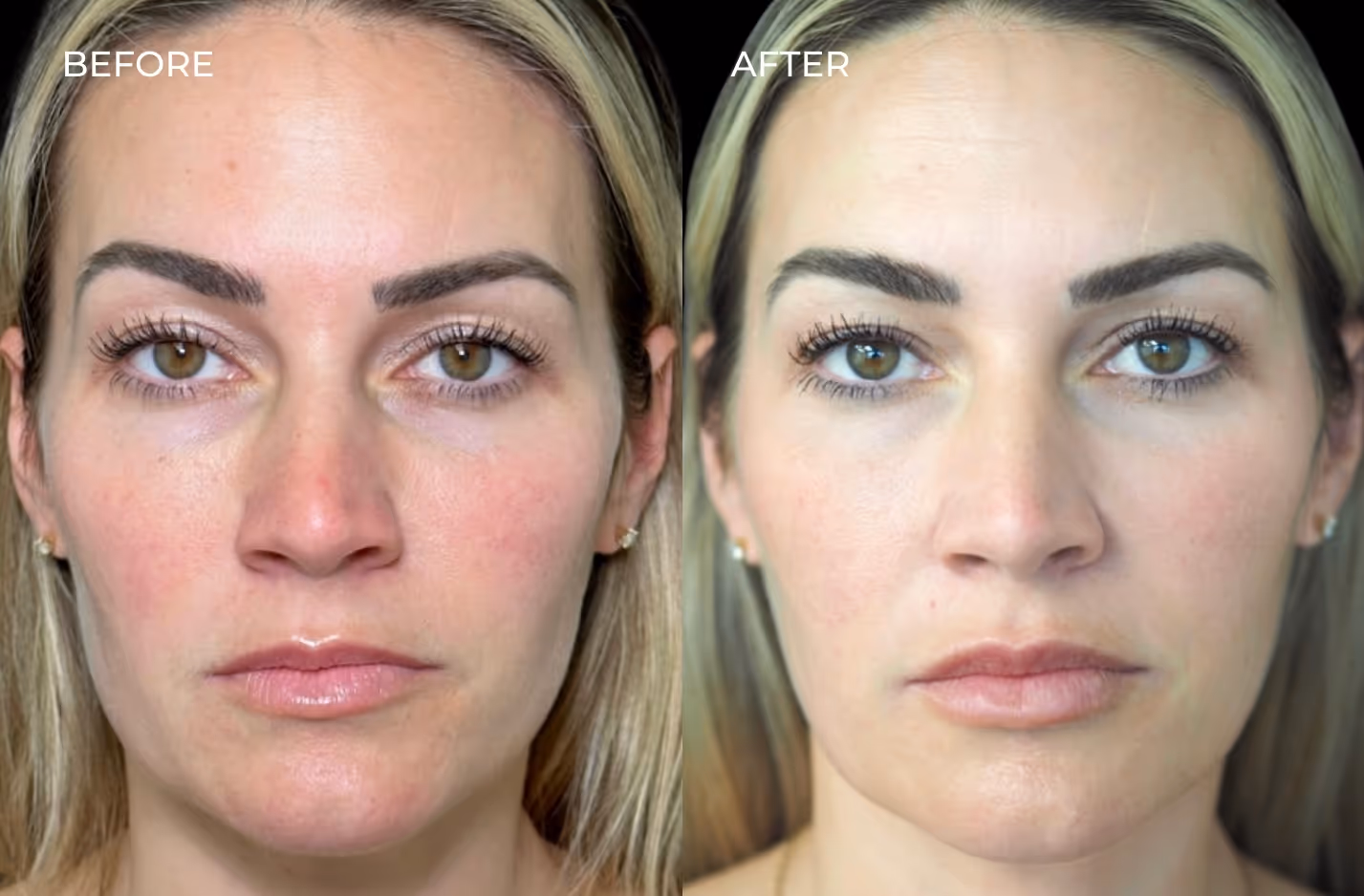 Frontal view of female patient before and after Sculptra and other injectables in San Diego