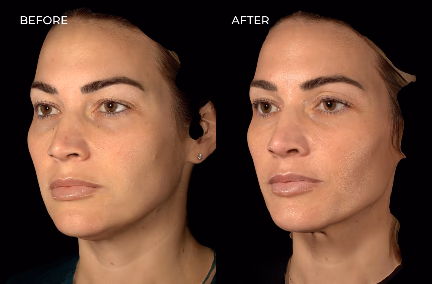 Female patient before and after botox and fillers in San Diego